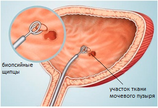 Узлы на мочевом пузыре что это такое