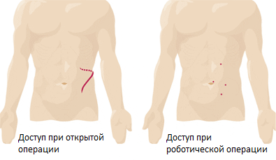 Лапароскопическая нефрэктомия (удаление почки) — Клиника Ланцетъ