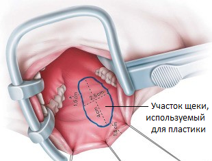 Что значит опущение уретры