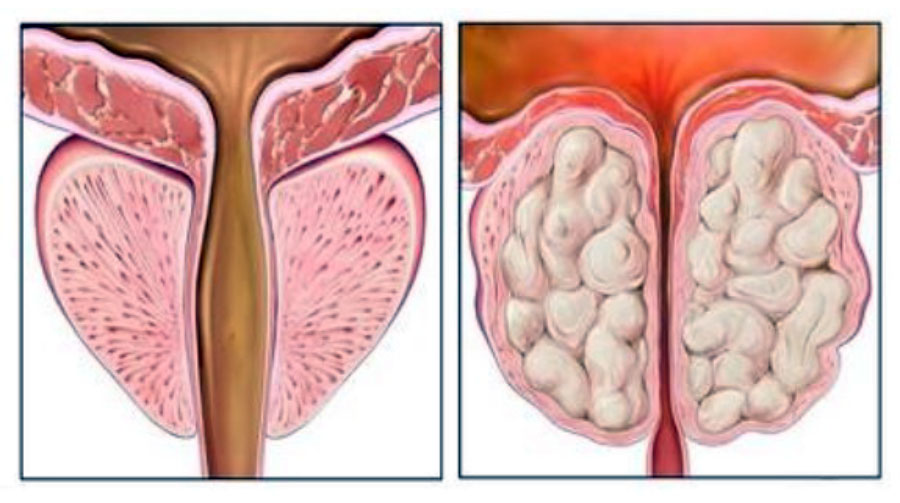 Абсцесс простаты