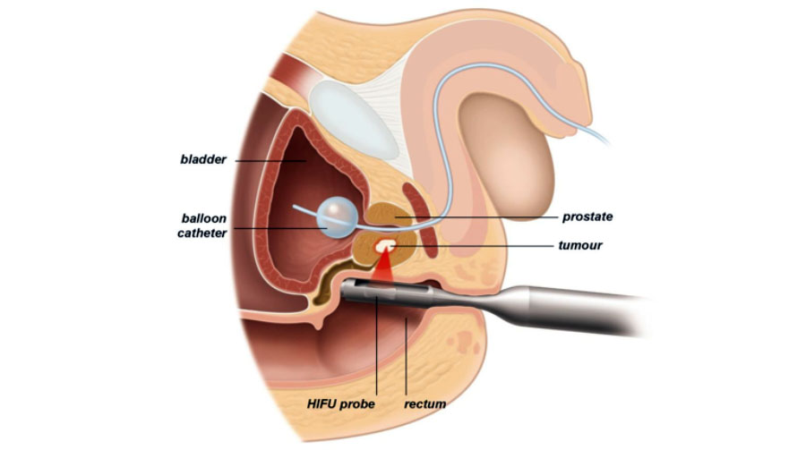 Sonda gastrica para que sirve