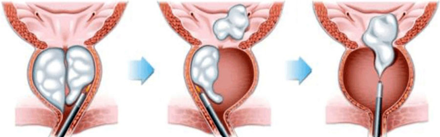 Схема выполнения лазерной энуклеации
