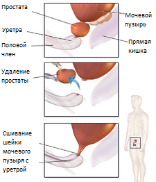 Аденома простаты: симптомы, диагностика и лечение