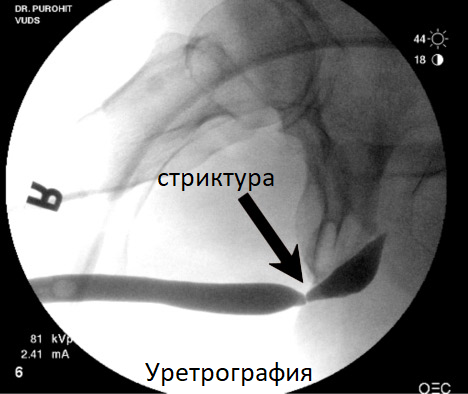 Стриктура уретры – симптомы, причины, признаки, диагностика и лечение в «СМ-Клиника»