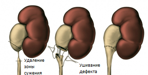 Узи гидронефроз фото